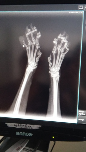 How can she lose a bone?!