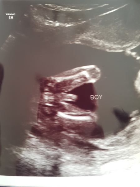 Scan picture inbetween the legs! Boy or girl?