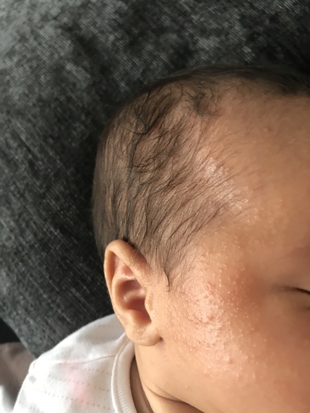 Help please one twin has a rash/ skin problem ???