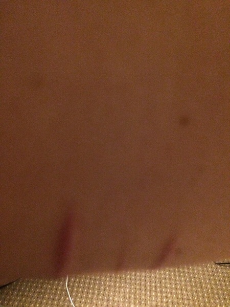 Self harm scar on arm