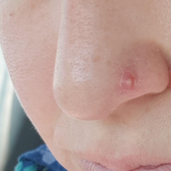 Horrible recurrent red swelling at tip of my nose - help!