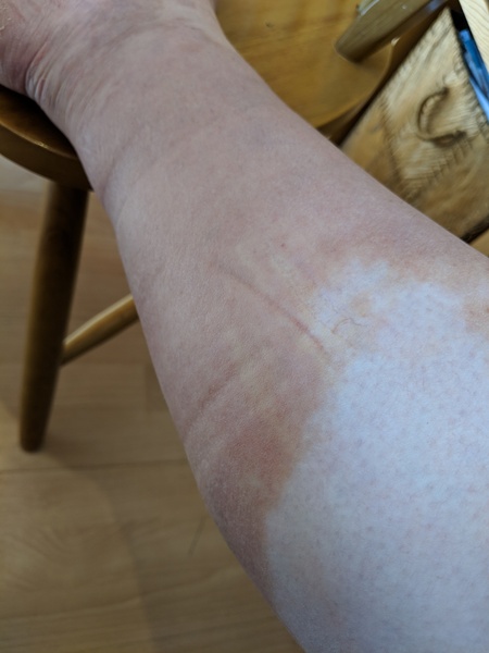 Cellulitis in ankle and lower leg returns.......