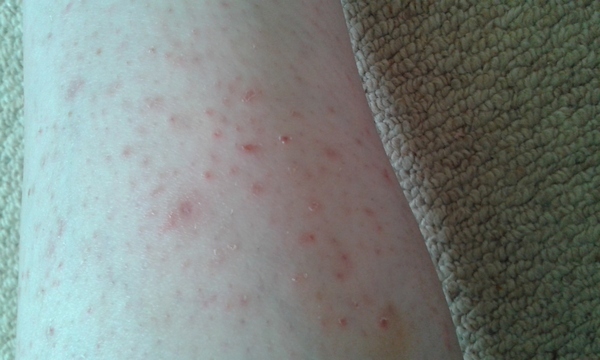 Ingrown hairs? :( :(