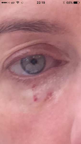 Syringoma