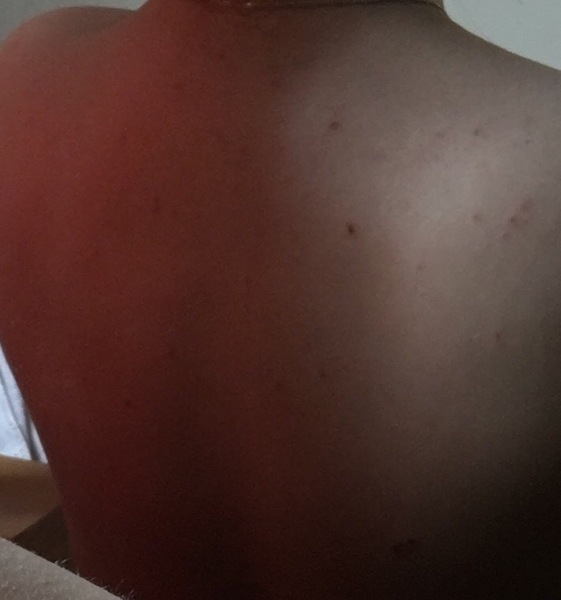 Please help me get rid of rash