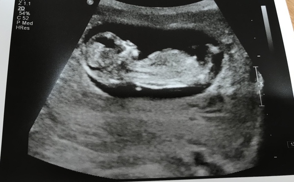 More cake for more babies... BFP after MC