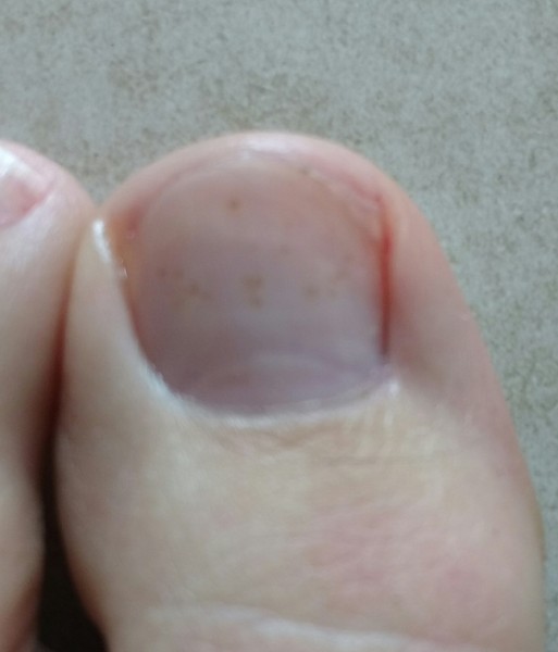 What are these weird freckles on my toe nail?