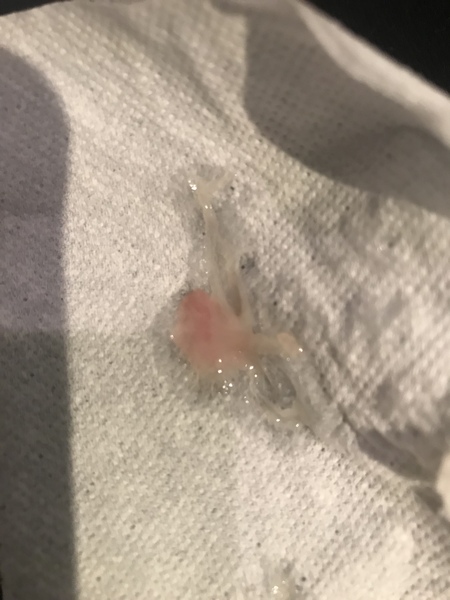 Stomach bug or labour?