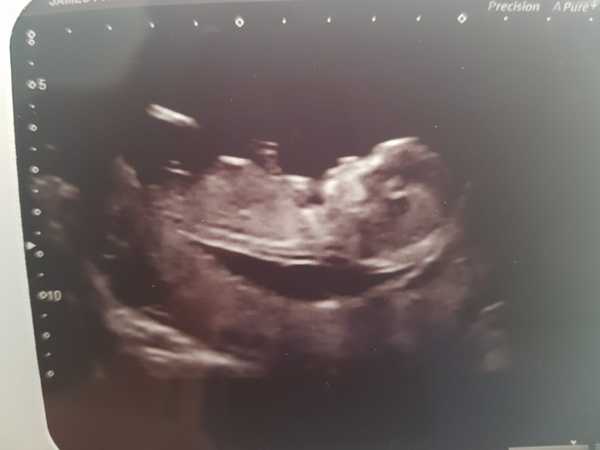 Nub Theory. Boy or Girl?