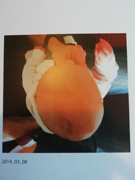 Has anyone regretted putting their baby in a helmet for plagiocephaly?