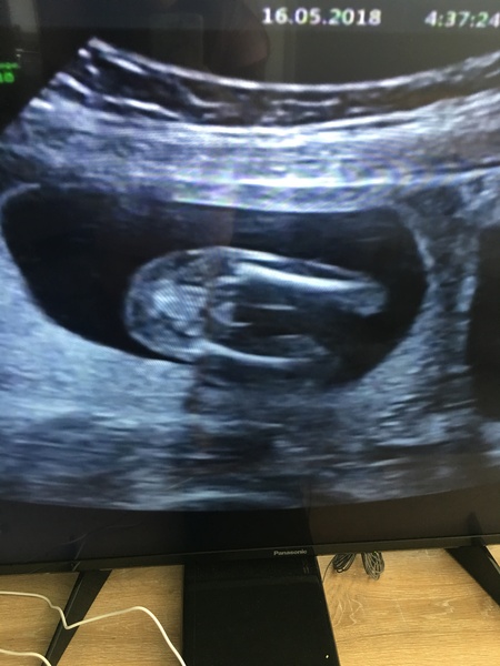 Scan picture inbetween the legs! Boy or girl?