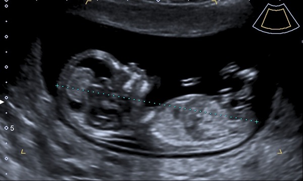 13 weeks nub theory