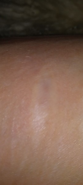 Self harm scar on arm