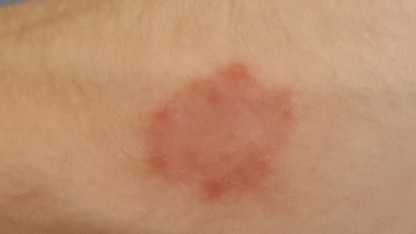 Is my arm incubating something?
