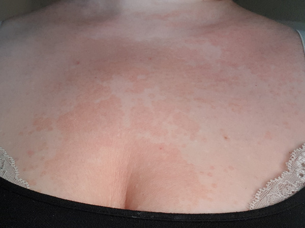 To ask if this looks like Psoriasis??? Pics Inside.