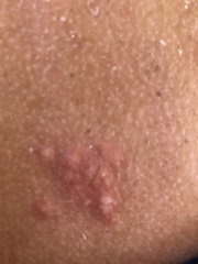 Does this look like shingles?