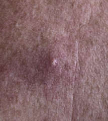 Cyst on back angry and grown an eye