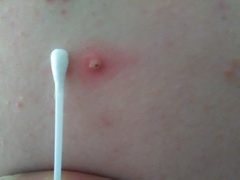 *Klaxon* big yellow zit