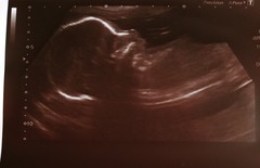Fresh Start thread for pregnancy after miscarriage or loss