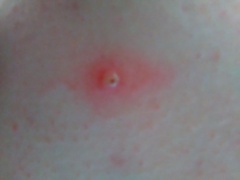 *Klaxon* big yellow zit