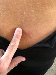 Does this look like shingles?