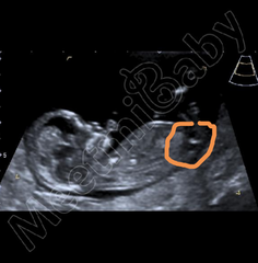 Nub Theory. Boy or Girl?
