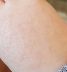 What is this rash
