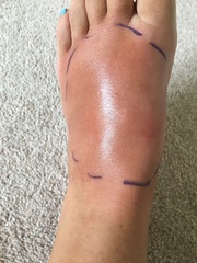 Any dr’s -swollen insect bite