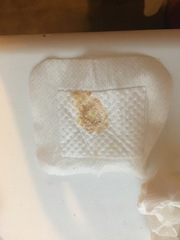 for your delectation - DH's infected sebaceous cyst