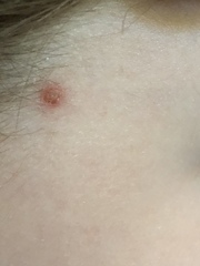 Your Help ref chicken pox please!