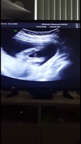 Scan picture inbetween the legs! Boy or girl?