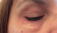 Puffiness around eyes