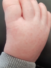 What is this rash