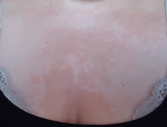To ask if this looks like Psoriasis??? Pics Inside.
