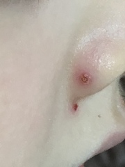 Your Help ref chicken pox please!