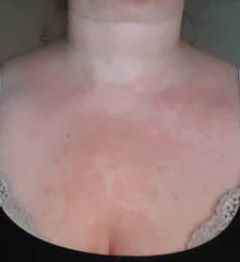 To ask if this looks like Psoriasis??? Pics Inside.