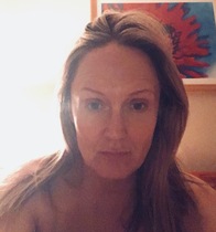 Has anyone had Botox to fix a downturned mouth?