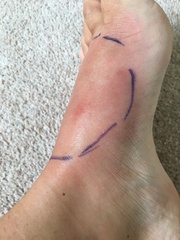 Any dr’s -swollen insect bite