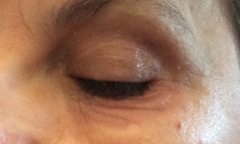 Puffiness around eyes