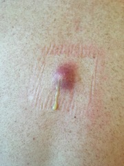 for your delectation - DH's infected sebaceous cyst