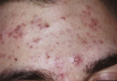 AIBU to ask for urgent skincare help. Getting married this weekend