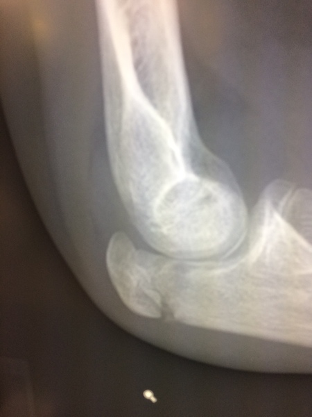 ds(12) broken elbow - second opinions