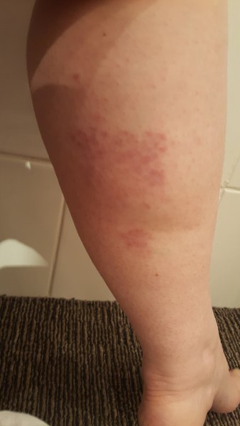 Could anyone diagnose this? Funny mark on leg...