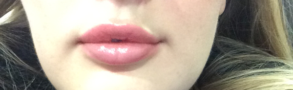 Sooo, who’s tried lip fillers?!