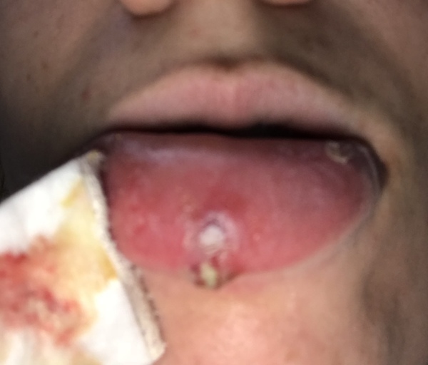 Aibu to ask how to treat an open wound - abscess in lip.