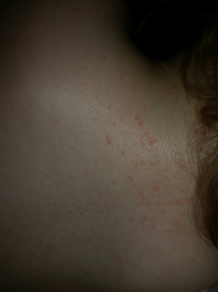 Is this pox?