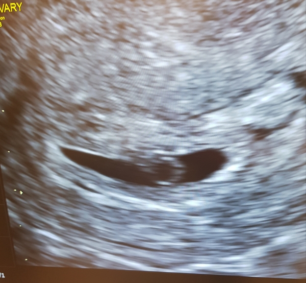 6 week scan and no foetal pole (pic)
