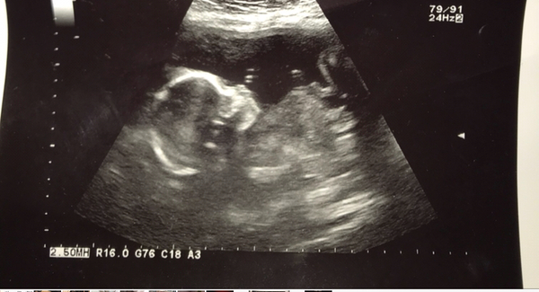 Boy or Girl Guessing