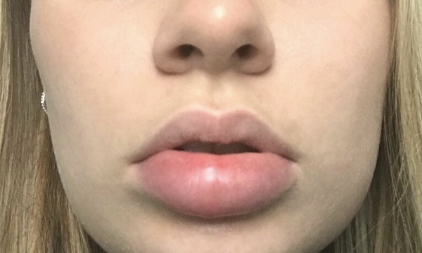 Aibu to ask how to treat an open wound - abscess in lip.
