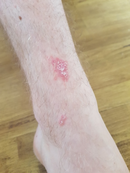 What is this on DP's legs?